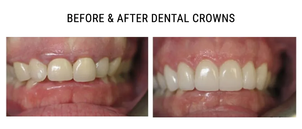 Before and after dental crowns