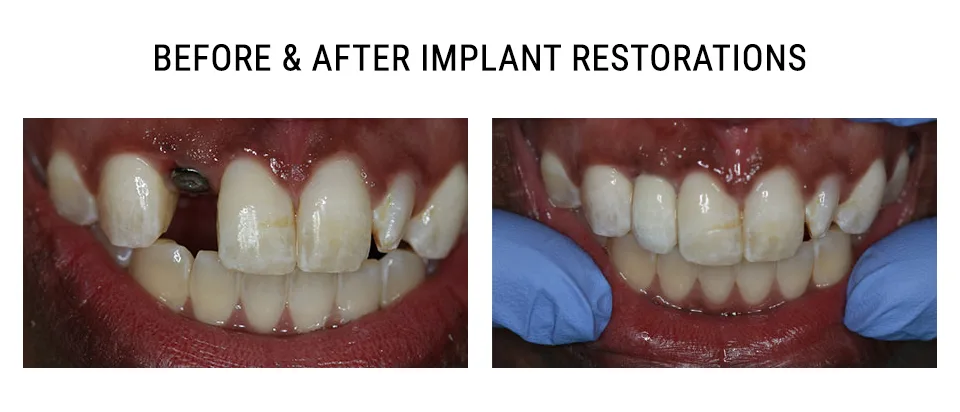 Before and after implant restoration