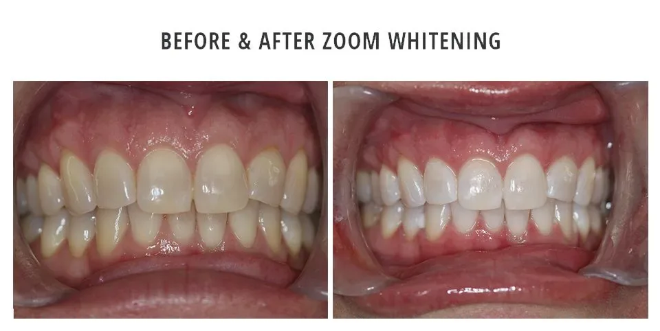 Before and after Zoom whitening